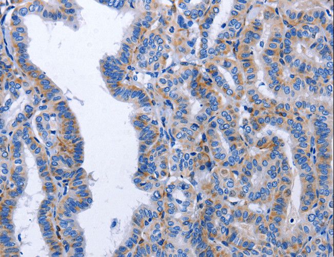 BDNF Antibody - Immunohistochemistry of paraffin-embedded Human thyroid cancer using BDNF Polyclonal Antibody at dilution of 1:40.