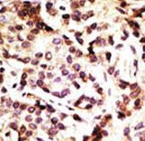 BECN1 / Beclin-1 Antibody - Formalin-fixed and paraffin-embedded human cancer tissue reacted with the primary antibody, which was peroxidase-conjugated to the secondary antibody, followed by DAB staining. This data demonstrates the use of this antibody for immunohistochemistry; clinical relevance has not been evaluated. BC = breast carcinoma; HC = hepatocarcinoma.