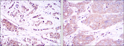 BECN1 / Beclin-1 Antibody - IHC of paraffin-embedded breast cancer tissues (left) and liver cancer tissues (right) using BECN1 mouse monoclonal antibody with DAB staining.