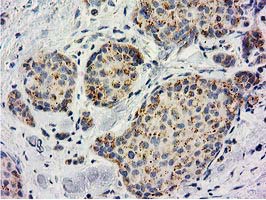 BECN1 / Beclin-1 Antibody - IHC of paraffin-embedded Adenocarcinoma of Human breast tissue using anti-BECN1 mouse monoclonal antibody. (Heat-induced epitope retrieval by 10mM citric buffer, pH6.0, 100C for 10min).