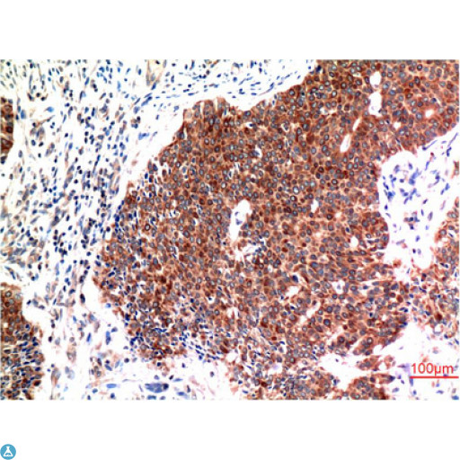 BECN1 / Beclin-1 Antibody - Immunohistochemistry (IHC) analysis of paraffin-embedded Human Breast Carcinoma Tissue using Beclin-1 Mouse Monoclonal Antibody diluted at 1:200.