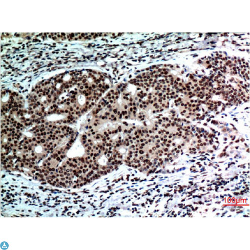 BECN1 / Beclin-1 Antibody - Immunohistochemistry (IHC) analysis of paraffin-embedded Human Breast Carcinoma Tissue using Beclin-1 Mouse Monoclonal Antibody diluted at 1:200.