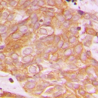 BEGAIN Antibody - Immunohistochemical analysis of BEGAIN staining in human breast cancer formalin fixed paraffin embedded tissue section. The section was pre-treated using heat mediated antigen retrieval with sodium citrate buffer (pH 6.0). The section was then incubated with the antibody at room temperature and detected with HRP and DAB as chromogen. The section was then counterstained with hematoxylin and mounted with DPX.