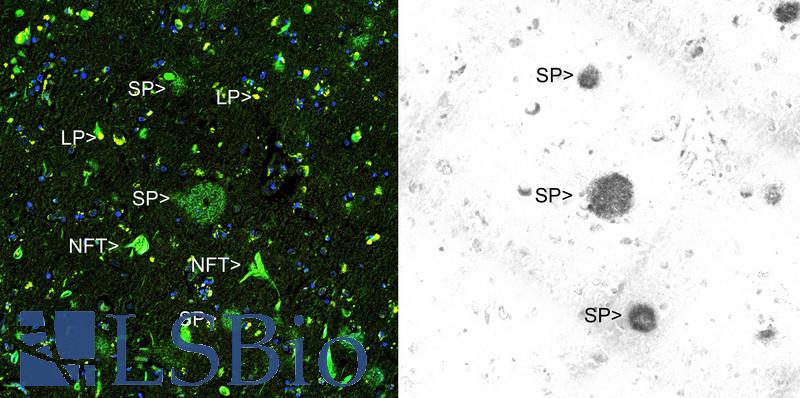 Beta Amyloid Antibody - Immunohistochemical analysis of paraffin-embedded Alzheimer's hippocampus using Thioflavin S (left panel) and Beta Amyloid antibody using the HRP-DAB staining technique. Left image shows a section stained with Thioflavin S, a fluorescent reagent which binds to both senile plaques (SP) and neurofibrillary tangles (NFT), the two hallmark lesions of Alzheimer's disease. Lipofuscin granules (LP) are seen in normal aging brain, but are autofluorescent and so can also be seen in this image. Beta Amyloid antibody show strong staining only of the senile plaques. The right image show Beta Amyloid antibody staining of an adjacent section, showing strong staining of the senile plaques, with more minor staining of blood vessels.