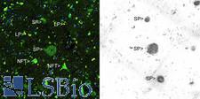 Beta Amyloid Antibody - Immunohistochemical analysis of paraffin-embedded Alzheimer's hippocampus using Thioflavin S (left panel) and Beta Amyloid antibody using the HRP-DAB staining technique. Left image shows a section stained with Thioflavin S, a fluorescent reagent which binds to both senile plaques (SP) and neurofibrillary tangles (NFT), the two hallmark lesions of Alzheimer's disease. Lipofuscin granules (LP) are seen in normal aging brain, but are autofluorescent and so can also be seen in this image. Beta Amyloid antibody show strong staining only of the senile plaques. The right image show Beta Amyloid antibody staining of an adjacent section, showing strong staining of the senile plaques, with more minor staining of blood vessels.