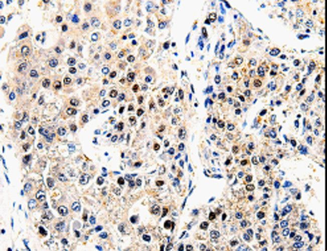 Beta Amyloid Antibody - Immunohistochemistry of paraffin-embedded Human liver cancer using APP Polyclonal Antibody at dilution of 1:100.