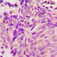 Beta Tubulin Antibody - Immunohistochemical analysis of Beta-tubulin staining in human breast cancer formalin fixed paraffin embedded tissue section. The section was pre-treated using heat mediated antigen retrieval with sodium citrate buffer (pH 6.0). The section was then incubated with the antibody at room temperature and detected using an HRP-conjugated compact polymer system. DAB was used as the chromogen. The section was then counterstained with hematoxylin and mounted with DPX.