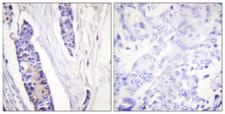Beta Tubulin Antibody - Peptide - + Immunohistochemistry analysis of paraffin-embedded human breast carcinoma tissue using Tubulin ß antibody.