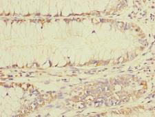 BEX1 Antibody - Immunohistochemistry of paraffin-embedded human colon cancer using BEX1 Antibody at dilution of 1:100
