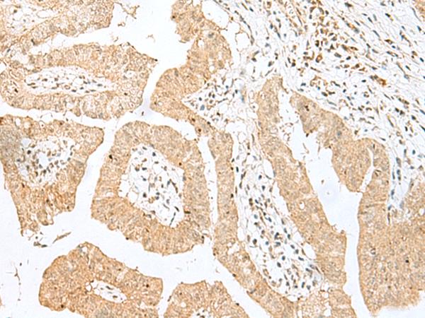 BEX2 Antibody - Immunohistochemistry of paraffin-embedded Human liver cancer tissue  using BEX2 Polyclonal Antibody at dilution of 1:50(×200)