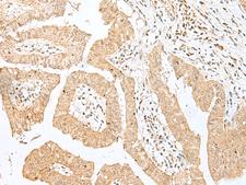 BEX2 Antibody - Immunohistochemistry of paraffin-embedded Human liver cancer tissue  using BEX2 Polyclonal Antibody at dilution of 1:50(×200)