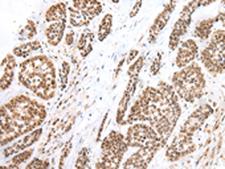 BF1 / FOXG1 Antibody - Immunohistochemistry of paraffin-embedded Human esophagus cancer tissue  using FOXG1  Polyclonal Antibody at dilution of 1:60(×200)