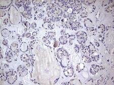 BFSP1 / Filensin Antibody - IHC of paraffin-embedded Carcinoma of Human thyroid tissue using anti-BFSP1 mouse monoclonal antibody. (Heat-induced epitope retrieval by 1 mM EDTA in 10mM Tris, pH8.5, 120°C for 3min).