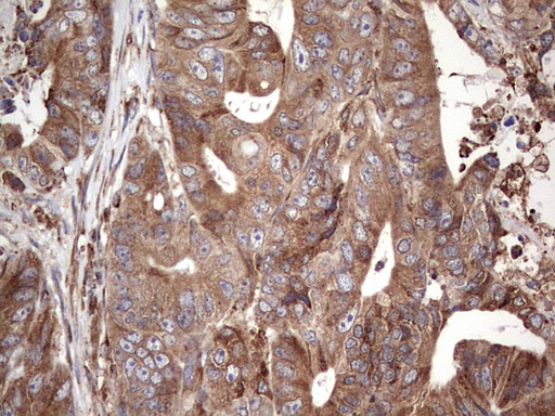 BFSP1 / Filensin Antibody - IHC of paraffin-embedded Adenocarcinoma of Human colon tissue using anti-BFSP1 mouse monoclonal antibody. (Heat-induced epitope retrieval by 1 mM EDTA in 10mM Tris, pH8.5, 120°C for 3min).