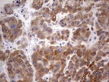 BFSP2 Antibody - Immunohistochemical staining of paraffin-embedded Carcinoma of Human liver tissue using anti-BFSP2 mouse monoclonal antibody. (Heat-induced epitope retrieval by 1 mM EDTA in 10mM Tris, pH8.5, 120C for 3min,