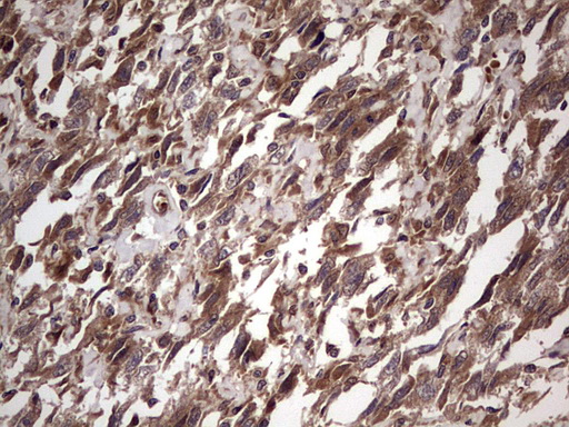 BFSP2 Antibody - Immunohistochemical staining of paraffin-embedded Adenocarcinoma of Human ovary tissue using anti-BFSP2 mouse monoclonal antibody. (Heat-induced epitope retrieval by 1 mM EDTA in 10mM Tris, pH8.5, 120C for 3min,