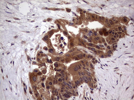 BFSP2 Antibody - Immunohistochemical staining of paraffin-embedded Carcinoma of Human pancreas tissue using anti-BFSP2 mouse monoclonal antibody. (Heat-induced epitope retrieval by 1 mM EDTA in 10mM Tris, pH8.5, 120C for 3min,