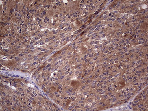 BFSP2 Antibody - Immunohistochemical staining of paraffin-embedded Human thyroid tissue within the normal limits using anti-BFSP2 mouse monoclonal antibody. (Heat-induced epitope retrieval by 1 mM EDTA in 10mM Tris, pH8.5, 120C for 3min,