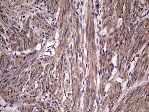 BFSP2 Antibody - Immunohistochemical staining of paraffin-embedded Human endometrium tissue within the normal limits using anti-BFSP2 mouse monoclonal antibody. (Heat-induced epitope retrieval by 1 mM EDTA in 10mM Tris, pH8.5, 120C for 3min,