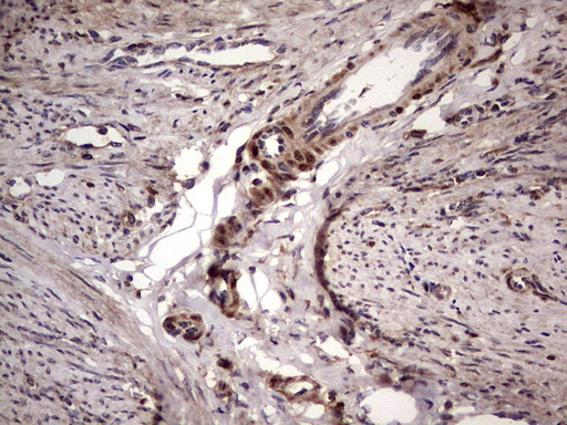 BFSP2 Antibody - Immunohistochemical staining of paraffin-embedded Adenocarcinoma of Human endometrium tissue using anti-BFSP2 mouse monoclonal antibody. (Heat-induced epitope retrieval by 1 mM EDTA in 10mM Tris, pH8.5, 120C for 3min,