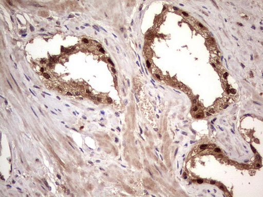 BFSP2 Antibody - Immunohistochemical staining of paraffin-embedded Human prostate tissue within the normal limits using anti-BFSP2 mouse monoclonal antibody. (Heat-induced epitope retrieval by 1 mM EDTA in 10mM Tris, pH8.5, 120C for 3min,