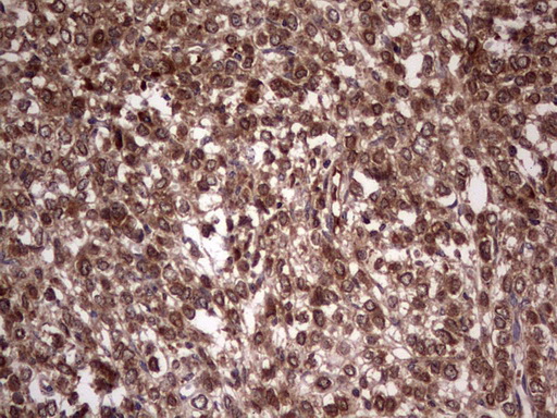 BFSP2 Antibody - Immunohistochemical staining of paraffin-embedded Adenocarcinoma of Human breast tissue using anti-BFSP2 mouse monoclonal antibody. (Heat-induced epitope retrieval by 1 mM EDTA in 10mM Tris, pH8.5, 120C for 3min,