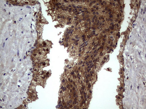 BFSP2 Antibody - Immunohistochemical staining of paraffin-embedded Carcinoma of Human prostate tissue using anti-BFSP2 mouse monoclonal antibody. (Heat-induced epitope retrieval by 1 mM EDTA in 10mM Tris, pH8.5, 120C for 3min,