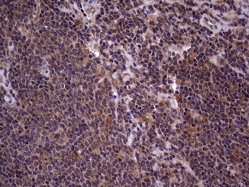 BFSP2 Antibody - Immunohistochemical staining of paraffin-embedded Human lymphoma tissue using anti-BFSP2 mouse monoclonal antibody. (Heat-induced epitope retrieval by 1 mM EDTA in 10mM Tris, pH8.5, 120C for 3min,