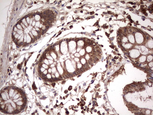 BFSP2 Antibody - Immunohistochemical staining of paraffin-embedded Human colon tissue within the normal limits using anti-BFSP2 mouse monoclonal antibody. (Heat-induced epitope retrieval by 1 mM EDTA in 10mM Tris, pH8.5, 120C for 3min,