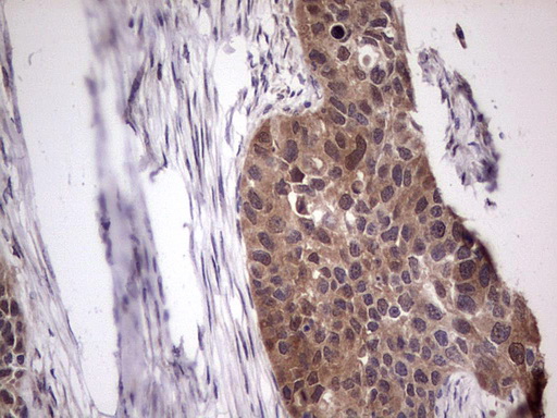 BFSP2 Antibody - Immunohistochemical staining of paraffin-embedded Carcinoma of Human kidney tissue using anti-BFSP2 mouse monoclonal antibody. (Heat-induced epitope retrieval by 1 mM EDTA in 10mM Tris, pH8.5, 120C for 3min,