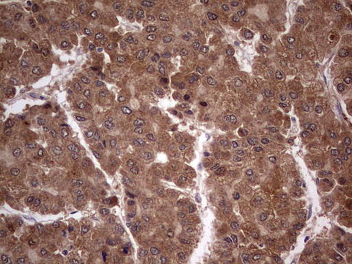 BFSP2 Antibody - Immunohistochemical staining of paraffin-embedded Carcinoma of Human liver tissue using anti-BFSP2 mouse monoclonal antibody. (Heat-induced epitope retrieval by 1 mM EDTA in 10mM Tris, pH8.5, 120C for 3min,