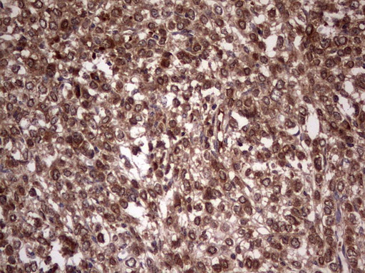 BFSP2 Antibody - IHC of paraffin-embedded Adenocarcinoma of Human breast tissue using anti-BFSP2 mouse monoclonal antibody. (Heat-induced epitope retrieval by 1 mM EDTA in 10mM Tris, pH8.5, 120°C for 3min).