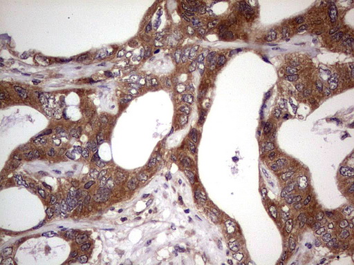 BFSP2 Antibody - IHC of paraffin-embedded Adenocarcinoma of Human colon tissue using anti-BFSP2 mouse monoclonal antibody. (Heat-induced epitope retrieval by 1 mM EDTA in 10mM Tris, pH8.5, 120°C for 3min).