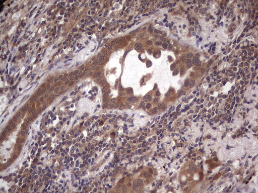 BFSP2 Antibody - IHC of paraffin-embedded Carcinoma of Human lung tissue using anti-BFSP2 mouse monoclonal antibody. (Heat-induced epitope retrieval by 1 mM EDTA in 10mM Tris, pH8.5, 120°C for 3min).