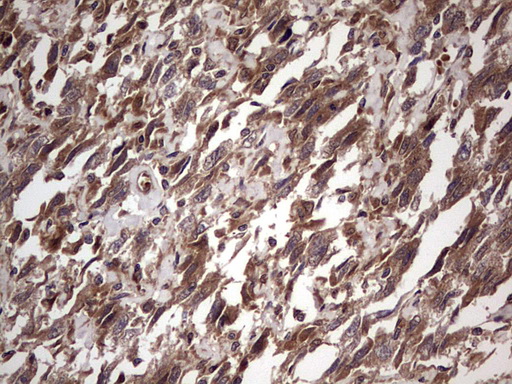 BFSP2 Antibody - IHC of paraffin-embedded Adenocarcinoma of Human ovary tissue using anti-BFSP2 mouse monoclonal antibody. (Heat-induced epitope retrieval by 1 mM EDTA in 10mM Tris, pH8.5, 120°C for 3min).