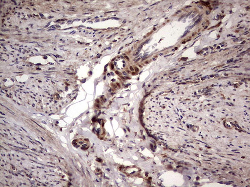 BFSP2 Antibody - IHC of paraffin-embedded Adenocarcinoma of Human endometrium tissue using anti-BFSP2 mouse monoclonal antibody. (Heat-induced epitope retrieval by 1 mM EDTA in 10mM Tris, pH8.5, 120°C for 3min).