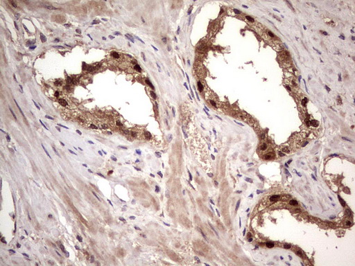 BFSP2 Antibody - IHC of paraffin-embedded Human prostate tissue using anti-BFSP2 mouse monoclonal antibody. (Heat-induced epitope retrieval by 1 mM EDTA in 10mM Tris, pH8.5, 120°C for 3min).