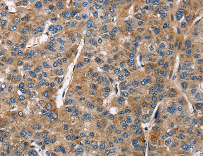 BGN / Biglycan Antibody - Immunohistochemistry of paraffin-embedded Human liver cancer using BGN Polyclonal Antibody at dilution of 1:50.