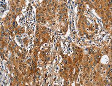 BGN / Biglycan Antibody - Immunohistochemistry of paraffin-embedded Human gastric cancer using BGN Polyclonal Antibody at dilution of 1:50.