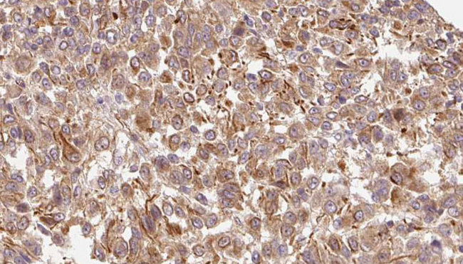 BGN / Biglycan Antibody - 1:100 staining human Melanoma tissue by IHC-P. The sample was formaldehyde fixed and a heat mediated antigen retrieval step in citrate buffer was performed. The sample was then blocked and incubated with the antibody for 1.5 hours at 22°C. An HRP conjugated goat anti-rabbit antibody was used as the secondary.