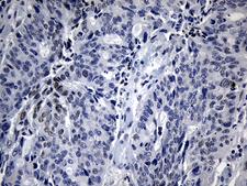 BHLHB2 / DEC1 Antibody - Immunohistochemical staining of paraffin-embedded Adenocarcinoma of Human colon tissue using anti-BHLHE40 mouse monoclonal antibody. (Heat-induced epitope retrieval by 1mM EDTA in 10mM Tris buffer. (pH8.5) at 120°C for 3 min. (1:150)