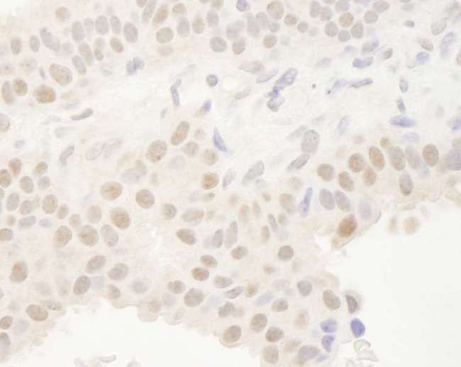 BHLHB2 / DEC1 Antibody - Detection of Human Dec1 by Immunohistochemistry. Sample: FFPE section of human breast carcinoma. Antibody: Affinity purified rabbit anti-Dec1 used at a dilution of 1:250.