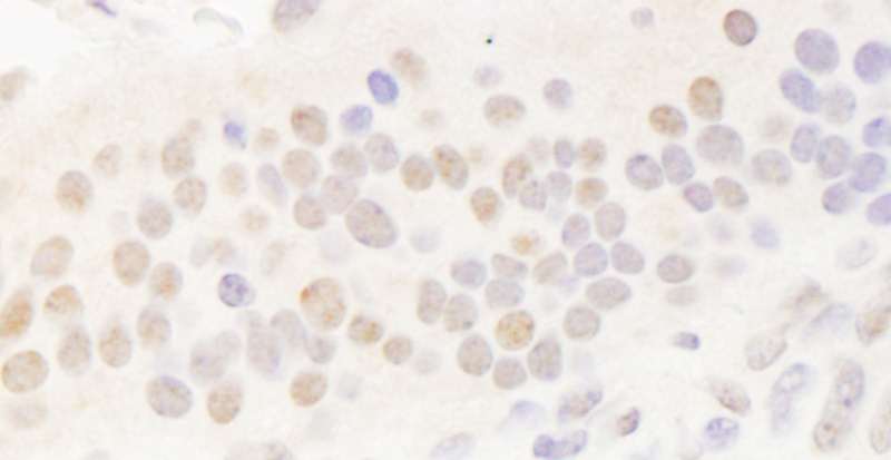 BHLHB2 / DEC1 Antibody - Detection of Human DEC1 by Immunohistochemistry. Sample: FFPE section of human breast carcinoma. Antibody: Affinity purified rabbit anti-DEC1 used at a dilution of 1:1000 (1 ug/ml). Detection: DAB.