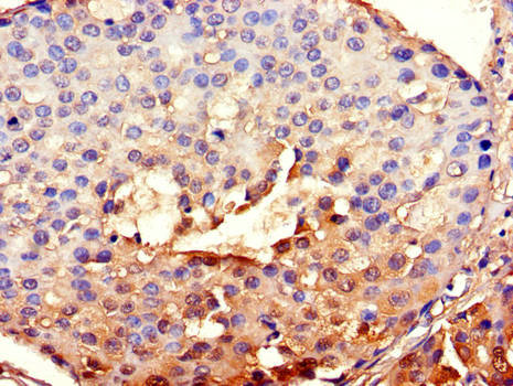 BHLHB2 / DEC1 Antibody - Immunohistochemistry of paraffin-embedded human breast cancer using BHLHE40 Antibody at dilution of 1:100