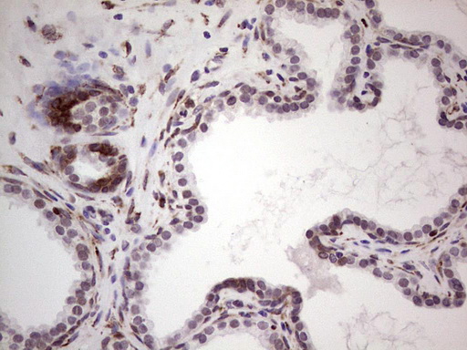 BHLHE41 / BHLHB3 / SHARP1 Antibody - IHC of paraffin-embedded Carcinoma of Human prostate tissue using anti-BHLHE41 mouse monoclonal antibody. (Heat-induced epitope retrieval by 1 mM EDTA in 10mM Tris, pH8.5, 120°C for 3min).