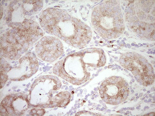 BHLHE41 / BHLHB3 / SHARP1 Antibody - Immunohistochemical staining of paraffin-embedded Adenocarcinoma of Human breast tissue using anti-BHLHE41 mouse monoclonal antibody. (Heat-induced epitope retrieval by 1 mM EDTA in 10mM Tris, pH8.5, 120C for 3min,