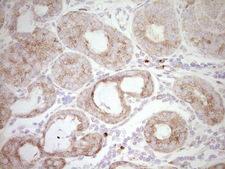 BHLHE41 / BHLHB3 / SHARP1 Antibody - Immunohistochemical staining of paraffin-embedded Adenocarcinoma of Human breast tissue using anti-BHLHE41 mouse monoclonal antibody. (Heat-induced epitope retrieval by 1 mM EDTA in 10mM Tris, pH8.5, 120C for 3min,