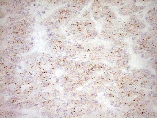BHLHE41 / BHLHB3 / SHARP1 Antibody - Immunohistochemical staining of paraffin-embedded Carcinoma of Human liver tissue using anti-BHLHE41 mouse monoclonal antibody. (Heat-induced epitope retrieval by 1 mM EDTA in 10mM Tris, pH8.5, 120C for 3min,
