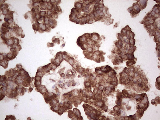 BHLHE41 / BHLHB3 / SHARP1 Antibody - Immunohistochemical staining of paraffin-embedded Adenocarcinoma of Human ovary tissue using anti-BHLHE41 mouse monoclonal antibody.  heat-induced epitope retrieval by 1 mM EDTA in 10mM Tris, pH8.5, 120C for 3min)