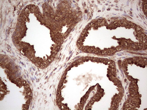 BHLHE41 / BHLHB3 / SHARP1 Antibody - Immunohistochemical staining of paraffin-embedded Carcinoma of Human prostate tissue using anti-BHLHE41 mouse monoclonal antibody.  heat-induced epitope retrieval by 1 mM EDTA in 10mM Tris, pH8.5, 120C for 3min)